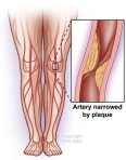 Legs Peripheral Artery Disease