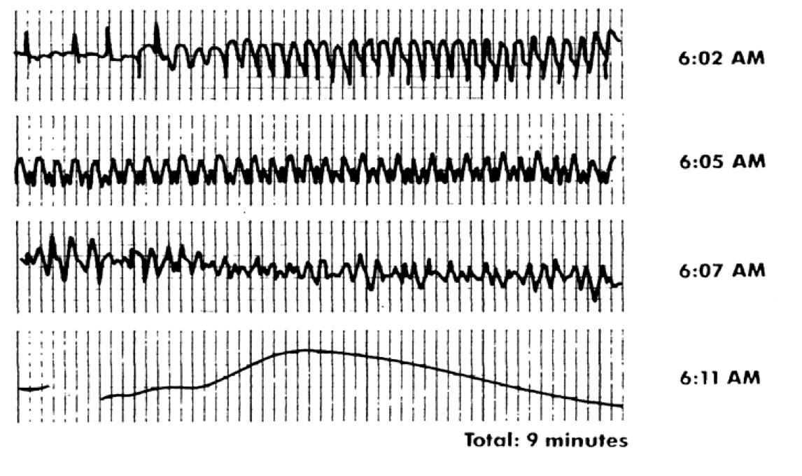 What sudden cardiac arrest looks like – Heart Sisters